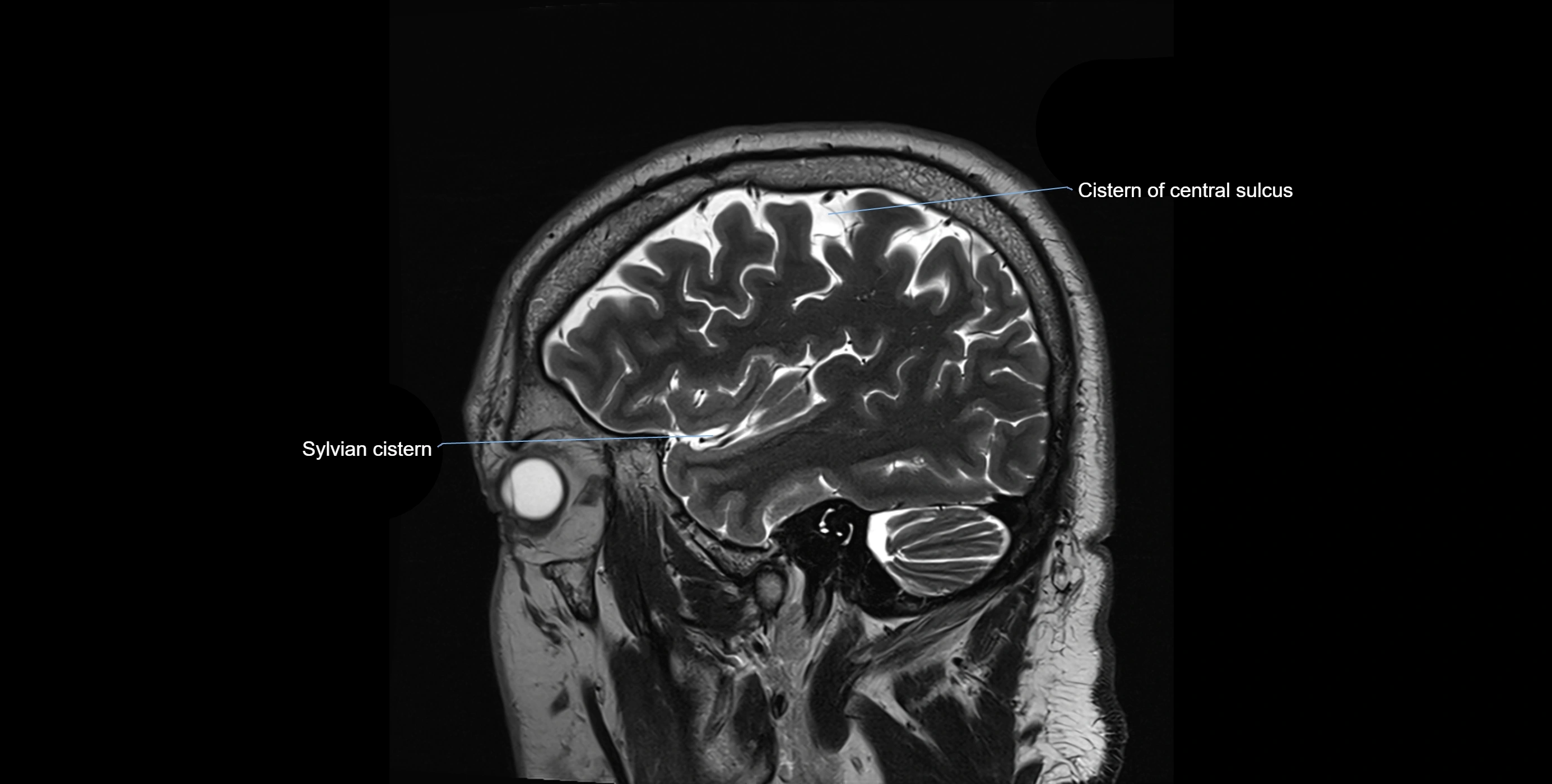 Brain cisterns  and ventricles sagittal anatomy 3T MRI image-img-00001-00010.webp